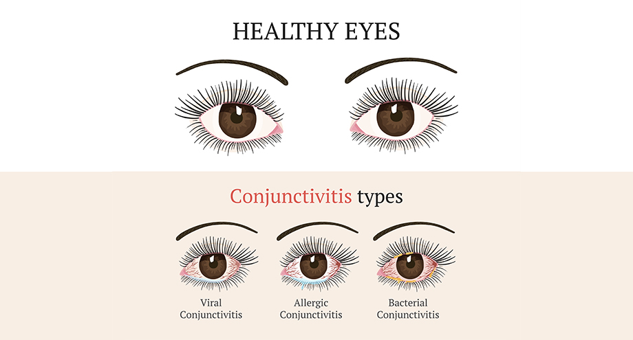 Conjunctivitis Pink Eye