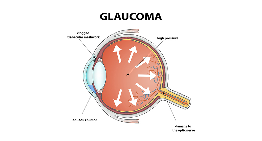 Glaucoma